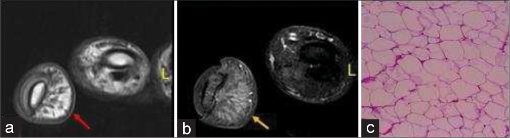 A 17-year-old female with lipoma of the finger presented with slowly progressive soft tissue swelling for years. (a) Non-contrast axial T1-weighted magnetic resonance image of the little finger showing fat and fibrous septa on volar surface (red arrow). (b) Axial fat saturated T2 weighted image demonstrates fat suppression (yellow arrow). (c) Histopathology confirmed the diagnosis revealing fat globules.