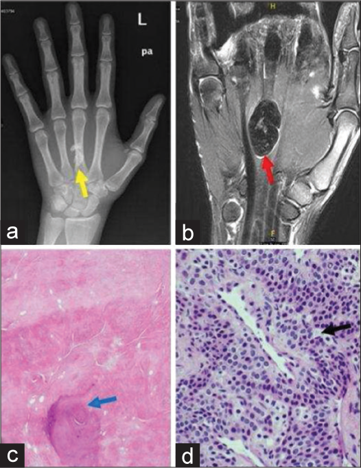 A 41-year-old male with fibroma of tendon sheath who presented with firm swelling on palm. (a) Plain radiograph of left hand shows a dense calcified lesion in metacarpal region (yellow arrow). (b) Non-contrast coronal T2-weighted magnetic resonance image of hand demonstrates profound T2 hypointense soft tissue mass along the palmar surface, deep to flexor digitorium tendons (red arrow). (c) Histopathology reveals bluish areas of calcification showing border between collagen fibers (blue arrow) (d) well-circumscribed nodules of dense fibrous tissue (black arrow) at ×40 magnification.