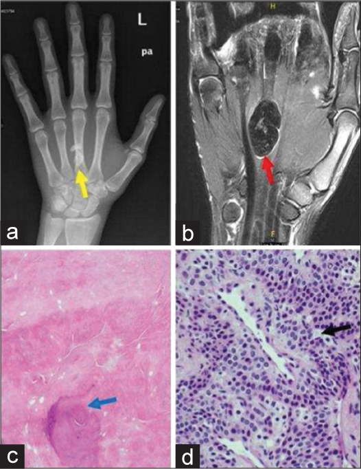 Common Soft Tissue Tumors Involving The Hand With Histopathological