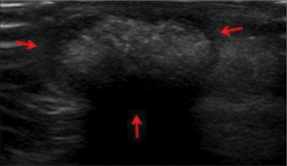 A 13-year-old boy with pilomatricoma who presented with dorsum of hand swelling. (a) Gray scale ultrasound image reveals superficial solid mass with typical hypoechoic rim (red arrows) and internal echogenic calcifications.