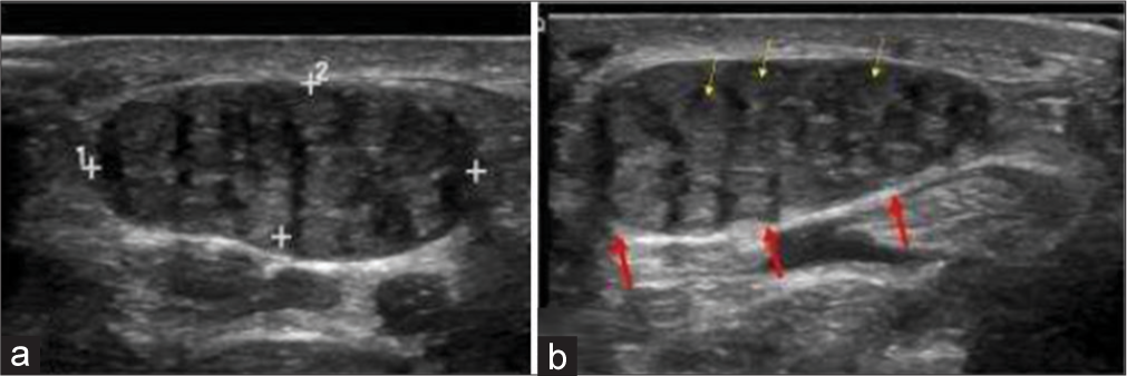 A 10-year-old girl with bilateral fibrolipomatous hamartomas of median nerve who presented with swelling around bilateral wrist and distal forearm. (a, b) Gray scale ultrasound images of proximal volar aspect of bilateral hands showing characteristic coaxial encasement of median nerves by solid echogenic heterogeneous substratum (red arrows). Note thin yellow arrows highlighting a few nerve fascicles on the background of fibrofatty replacement.