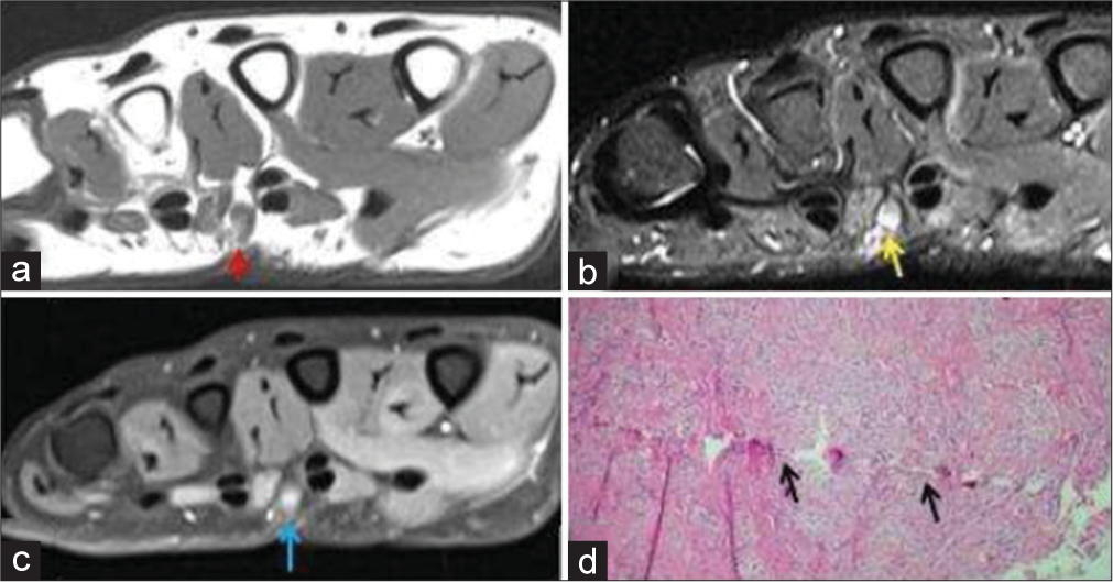 A 50-year-old male with traumatic neuroma presented with palmar swelling around scar site. (a) Non-contrast T1-weighted axial image shows a T1 hypointense small nodular lesion in palmar aspect of hand (red arrow). (b) The lesion is hyperintense on axial fat saturated T2-weighted image (yellow arrow). (c) It shows post-contrast enhancement (blue arrow). (d) Histopathology shows axons, Schwann cells, perineurial fibroblasts with scar tissue, thus confirming the diagnosis with a history of prior penetrating soft tissue injury.