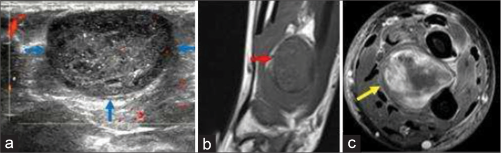 A 45-year-old woman with schwannoma who presented with swelling around wrist region. (a) Color Doppler ultrasound image showing a well-defined oval hypoechoic mass with smooth outline and hypoechoic rim. Note the trace internal vascularity within the mass (b) Non-contrast T1-weighted sagittal. Magnetic resonance images (MRI) image of the same patient showing well-defined hypointense mass with split-fat sign (red arrow). (c) Fat saturated axial T1-weighted contrast-enhanced MRI image shows heterogeneous enhancement of the mass (yellow arrow) with central necrosis.