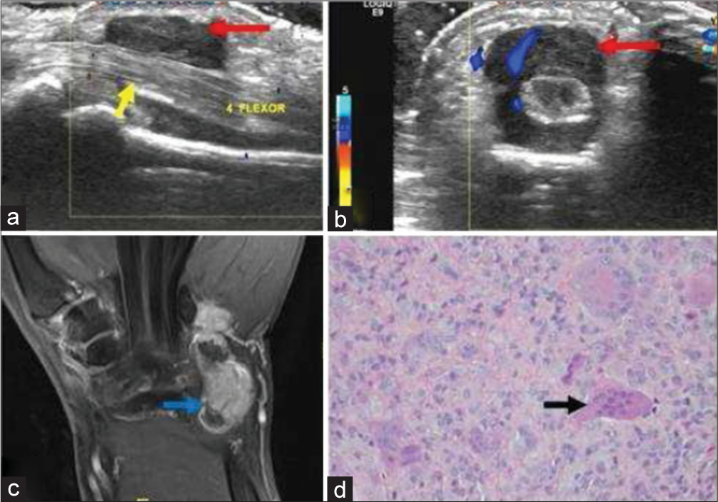 A 40-year-old male with giant cell tumor of tendon sheath who presented with progressive swelling of palmar surface of the hand. (a) Gray scale sagittal ultrasound image of the proximal hand demonstrates a well-defined hypoechoic soft tissue mass (red arrow) encasing the 4th flexor muscle tendon of the hand (yellow arrow). (b) Color Doppler shows internal vascularity within the mass (red arrow). (c) Post-contrast fat saturated T1-weighted coronal image in another patient with the same diagnosis showing nodular heterogeneous enhancement (blue arrow). (d) Histopathology reveals mononuclear cells and osteoclast-like giant cells (black arrow).