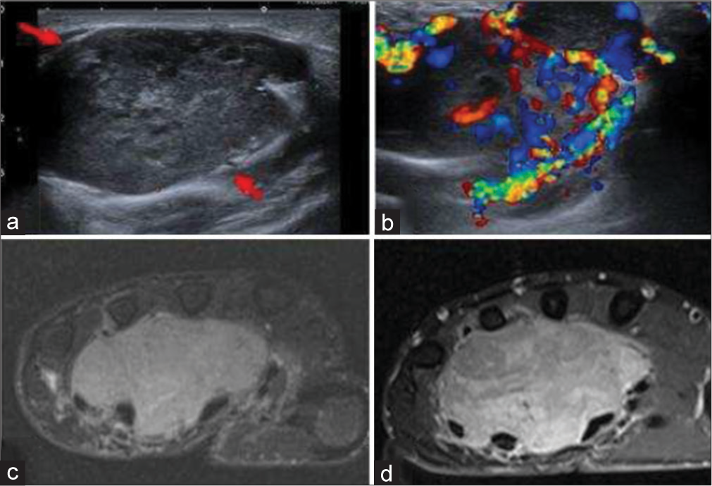 A 30-year-old woman with synovial sarcoma of hand who presented with slow-growing mass on hand. (a) Gray scale ultrasound image shows a well-defined solid and heterogeneous lobulated mass in volar surface of the right hand (red arrows). (b) Color Doppler shows significant color flow. (c) Fat saturated axial T2-weighted image showing hyperintense lobulated and insinuating mass, (d) with heterogeneous enhancement on post-contrast fat saturated T1-weighted axial image.