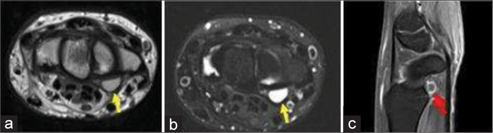 A 35-year-old man with ganglion cyst who presented with painless swelling over the proximal hand. (a) Non-contrast T1-weighted axial image showing a well-defined hyperintense lesion on the volar surface due to proteinaceous contents (yellow arrow). (b) Axial T2-weighted Magnetic resonance image at the level of wrist confirms a well-defined cystic lesion in volar surface adjacent to the flexure retinaculum (yellow arrow). (c) Fat saturated post-contrast sagittal T1 image shows rim enhancement of the cyst (red arrow).
