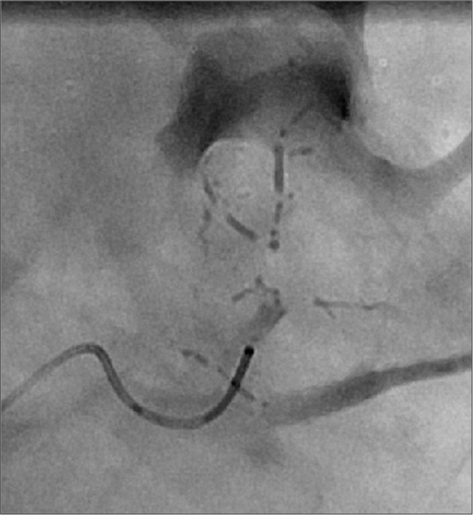 Fluoroscopic spot image of subsegmental renal artery being embolized with ethanol:ethiodol in the form of “oil bullets.” The 6:1 ratio of ethanol:ethiodol offers adequate radio-opacity while providing effective embolic properties.