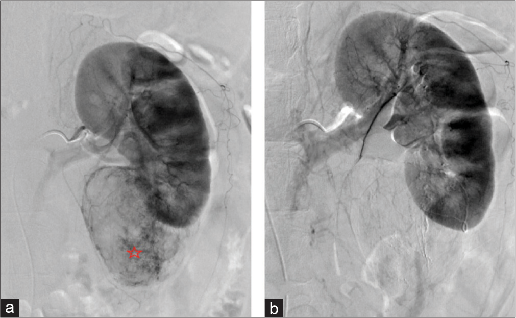 A 64-year-old woman with an incidental angiomyolipoma (AML) found during imaging for bowel resection. (a) Digital subtraction angiography of the left renal artery demonstrating the contrast-enhancing AML (red star) off the inferior pole of the left kidney. (b) Digital subtraction angiography of left renal artery postembolization demonstrating lack of enhancement of AML indicating technical success of embolization procedure.