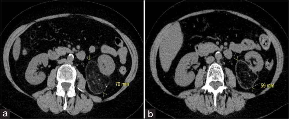 A 64-year-old woman with an incidental angiomyolipoma (AML). (a) Axial computed tomography (CT) of the abdomen and pelvis demonstrating the AML off the inferior pole of the left kidney measuring 70 mm. (b) Axial CT of the abdomen and pelvis at an 18-month follow-up showing shrinkage of the AML measuring 59 mm.