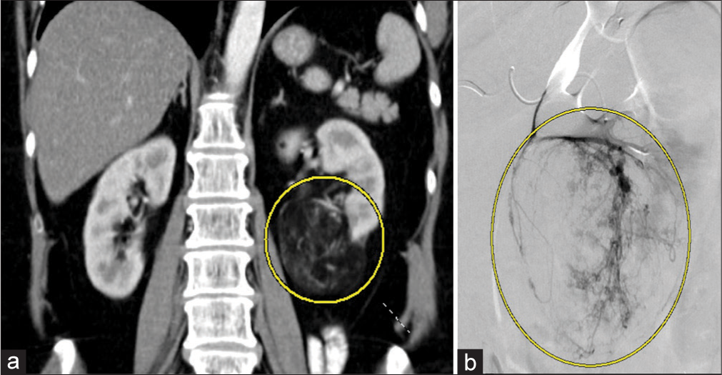 A 64-year-old woman with an incidental angiomyolipoma (AML). (a) Coronal computed tomography of the abdomen and pelvis demonstrating the AML (yellow circle) off the inferior pole of left kidney measuring 70 mm. (b) Digital subtraction angiography of a subsegmental renal artery demonstrating contrast enhancement of the AML off the inferior pole of the left kidney.