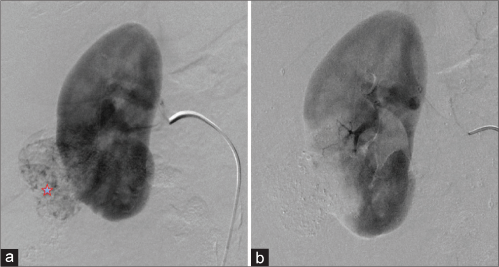 A 57-year-old female presenting with hematuria with subsequent diagnosis of angiomyolipoma (AML). (a) Digital subtraction angiography of the right renal artery demonstrating the contrast-enhancing AML (red star) off the inferior pole of right kidney. (b) Digital subtraction angiography of the right renal artery postembolization demonstrating lack of enhancement of AML indicating technical success of AML embolization.