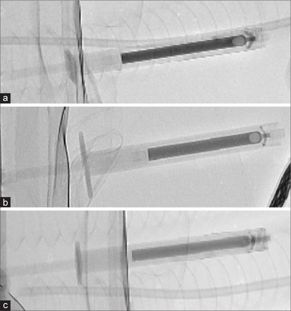 Fluoroscopy image of various ethanol:ethiodol ratios. (a) The ethanol:ethiodol ratio is 4:1 demonstrating highest level of radio-opacity. (b) The ethanol:ethiodol ratio is at 6:1. (c) The ethanol:ethiodol ratio is 9:1 with the least level of radio-opacity.