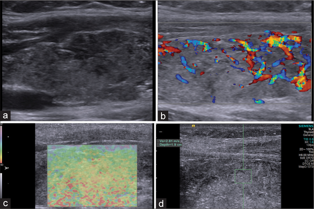 Patient with Hashimoto’s thyroiditis: (a) Grayscale ultrasound showing hypoechoic heterogeneous echopattern. (b) Color Doppler: Type II pattern. (c) Elstogram reveals type III pattern. (d) Shear wave velocity 2.81 m/s (depth 1.9 cm).