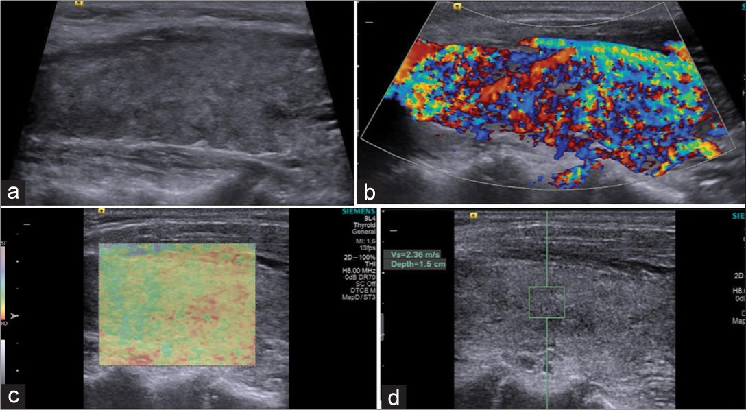 Patient with Graves’ disease: (a) Grayscale ultrasound showing hypoechoic echopattern. (b) Color Doppler: Type III pattern (thyroid inferno). (c) Elstogram reveals type II pattern. (d) Shear wave velocity 2.36 m/s (depth 1.5 cm).