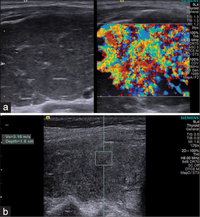 Patient with Graves’ disease: (a): Hypoechoic parenchyma with marked hypervascularity. (b): Shear wave velocity = 3.16 m/s (depth = 1.6 cm).