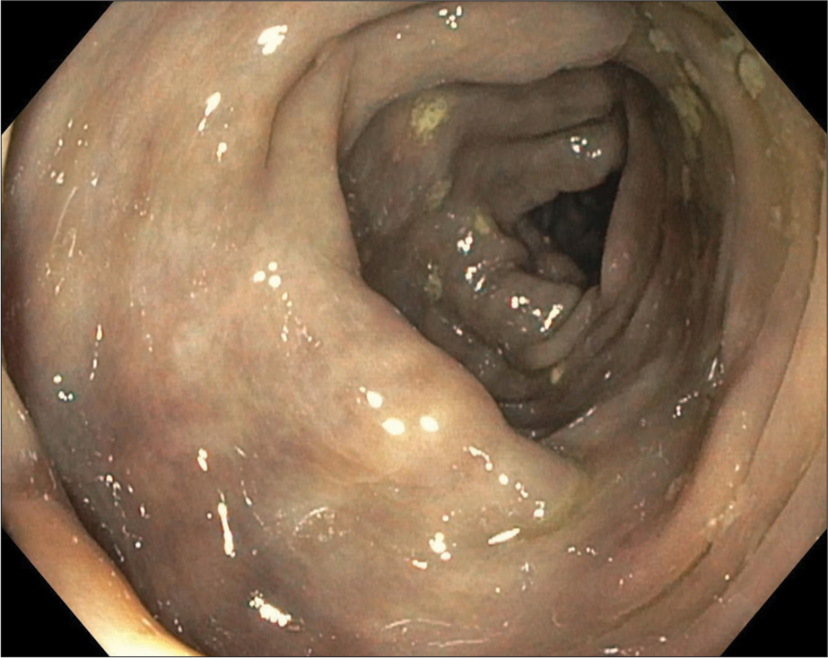 A 60-year-old female with fecal immunochemical test positive and recent onset (3–4 months) of intermittent abdominal pain with loose stools. Colonoscopy image at the splenic flexure showing a dusky and friable appearing colon.