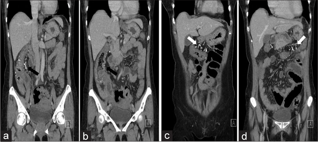 A 60-year-old female with fecal immunochemical test positive and recent onset (3–4 months) of intermittent abdominal pain with loose stools. Coronal reformatted computed tomography images showing colonic wall thickening involving the cecum, ascending colon (a and b), and transverse colon (c) up to the splenic flexure (d), with characteristic threadlike or serpentine calcified subserosal and mesenteric veins (arrows) in the distribution along these bowel loops.