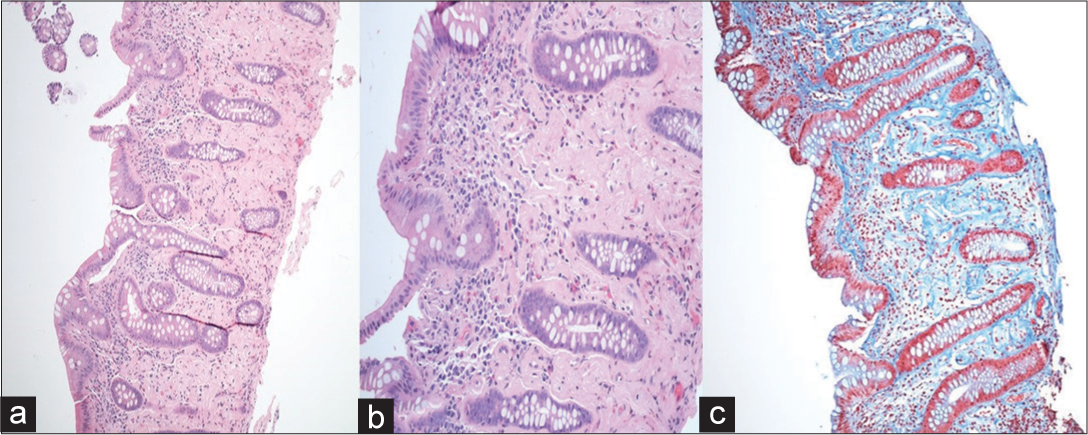 A 60-year-old female with fecal immunochemical test positive and recent onset (3–4 months) of intermittent abdominal pain with loose stools. Histopathological images of the ascending colon shot at ×100 and ×200 routine ×200 (routine H and E stains) (a and b), and ×100 for the Masson’s trichrome stain (c) showing diffuse crypt distortion with patchy lymphoplasma eosinophilic infiltrate, crypt atrophy, and moderate degree of crypt loss. The surface epithelium shows mild damage. There are marked lamina propria hyalinization and fibrosis as clearly highlighted in the Masson’s trichrome stain (c). All these features are in keeping with chronic ischemic changes that are consistent with phlebosclerotic colitis.