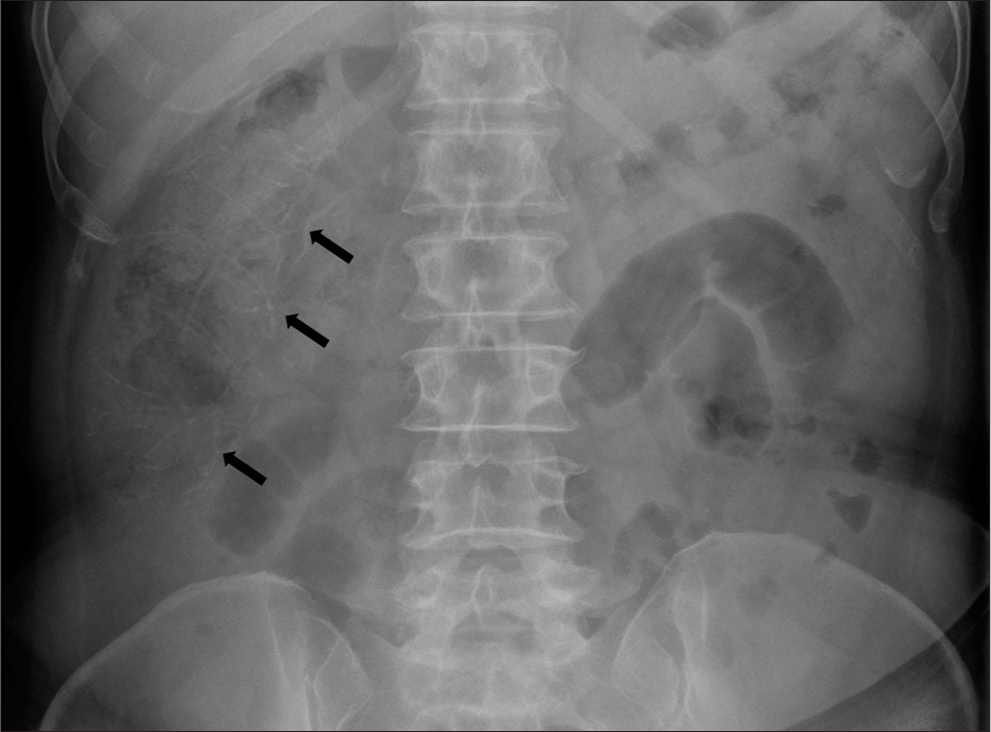 A 60-year-old female with fecal immunochemical test positive and recent onset (3–4 months) of intermittent abdominal pain with loose stools. Magnified abdominal radiograph showing faint threadlike linear calcifications (arrows) oriented along the ascending colon.