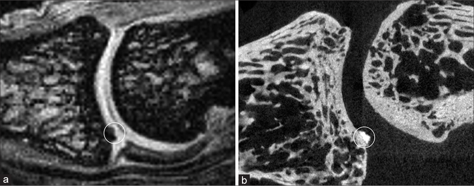 In this proximal interphalangeal joint, calcification inside the cartilage (circle) was observed on the sagittal (a) interleaved water-fat water + fat image as on the (b) microcomputed tomography image.