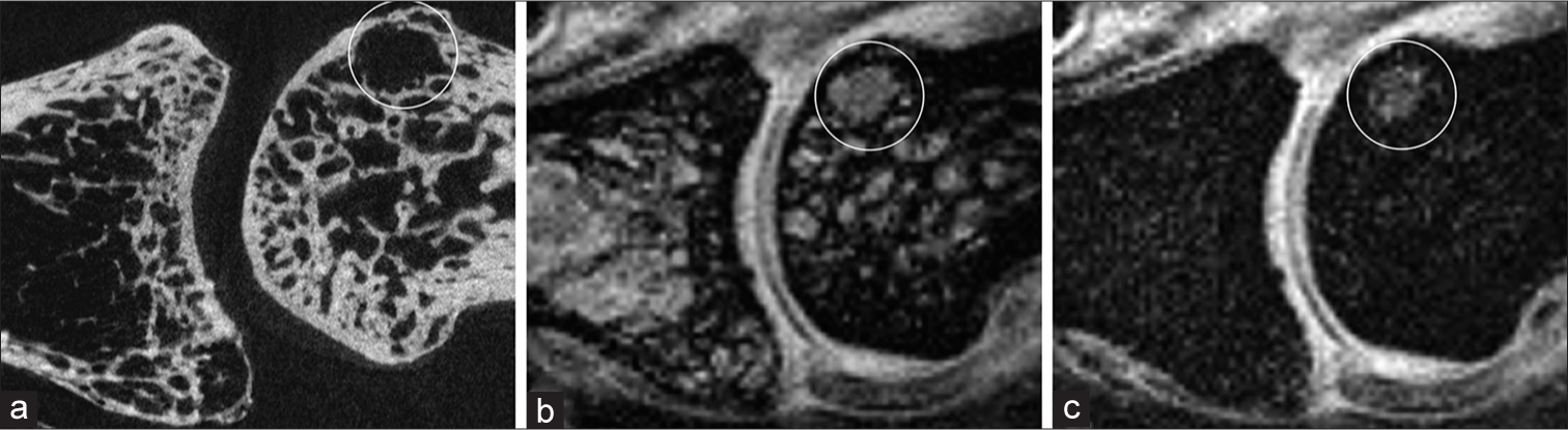 A subchondral defect (circle) was seen in this proximal interphalangeal joint on the sagittal (a) microcomputed tomography and (b) interleaved water-fat water + fat images. The (c) interleaved water-fat water-only image revealed its water content and identified it as a cyst.