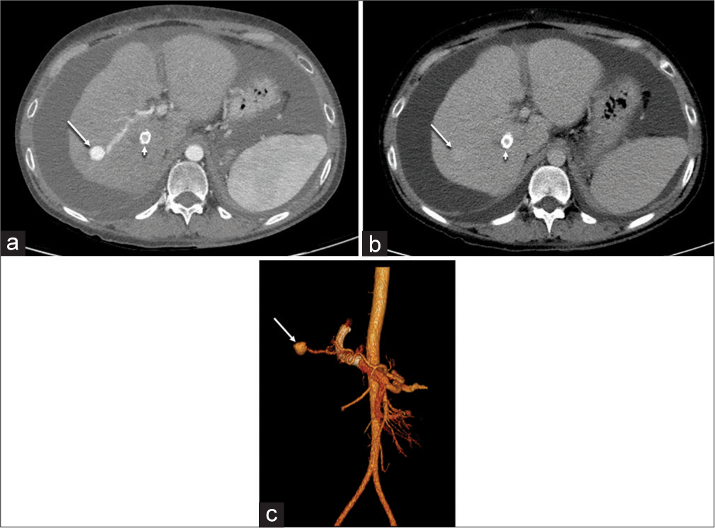 (a) Axial computed tomography angiography in the arterial phase demonstrate a round 1.5-cm lesion in the right hepatic lobe (arrow) with contrast enhancement that matches the arterial blood pool. The newly placed transjugular intrahepatic portosystemic shunt is also visible (arrowhead). (b) Axial contrast-enhanced computed tomography image in the delayed phase demonstrates a faintly enhancing lesion in the right hepatic lobe (arrow) with enhancement that matches the blood pool. The newly placed transjugular intrahepatic portosystemic shunt is also visible (arrowhead). (c) Volume-rendered image from computed tomography angiography demonstrates the hepatic artery pseudoaneurysm (arrow).