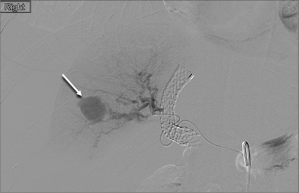 Conventional angiography with selective catheterization of the right hepatic artery demonstrates the enhancing pseudoaneurysm (arrow).