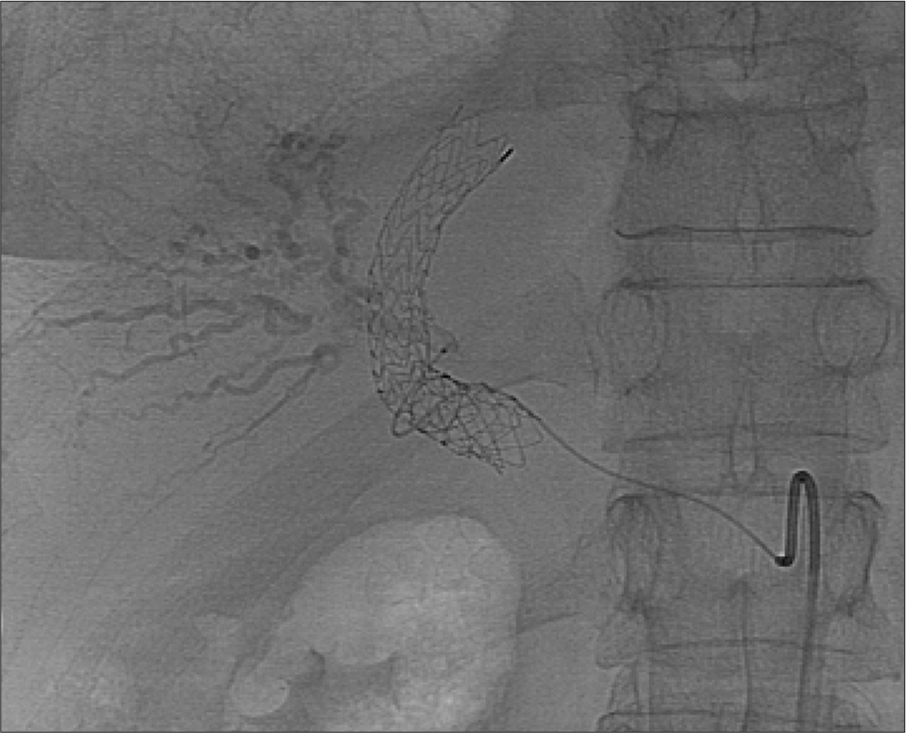 Conventional angiography with selective catheterization of the right hepatic artery following percutaneous thrombin injection demonstrates nonopacification of the pseudoaneurysm compatible with complete thrombosis.