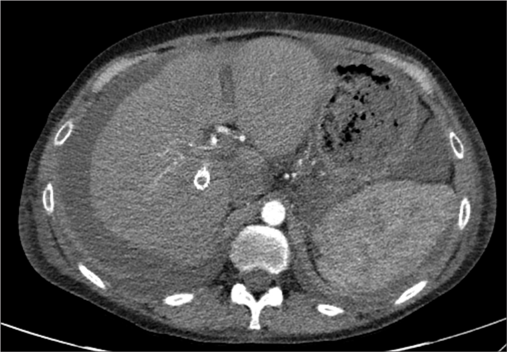 Axial computed tomography angiography performed the day following thrombin injection confirms complete thrombosis of the pseudoaneurysm which is no longer visible.