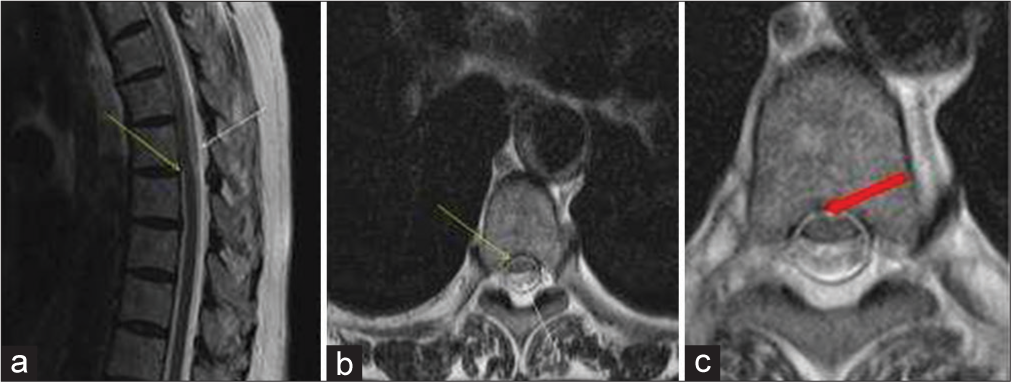 A 67-year-old female who presented with complains slowly progressing bilateral leg weakness with associated chronic low back pain. (a) Sagittal and (b) Axial T2-weighted image of the thoracic spine demonstrating anterior displacement of the spinal cord with an associated kink at T6 level (Yellow arrows) with CSF pulsation artifacts in the posterior subarachnoid space (White arrows). (c) High-resolution thin slice T2-weighted image demonstrates a subtle small focus of herniated cord through the dural defect (Red arrow). The findings favor spinal cord herniation instead of a posterior arachnoid cyst.