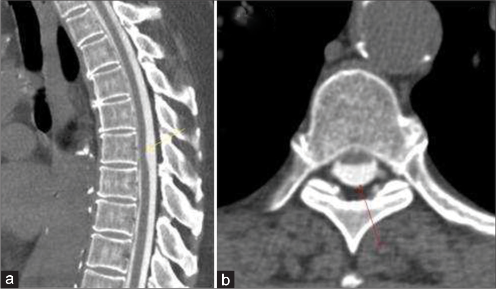 A 67-year-old female who presented with complains slowly progressing bilateral leg weakness with associated chronic low back pain. (a) Sagittal and (b) Axial CT Myelogram images of the thoracic spine demonstrating anterior cord kink at T6 (Yellow arrow) with complete opacification of CSF posterior to the anteriorly displaced spinal cord (Red arrow).