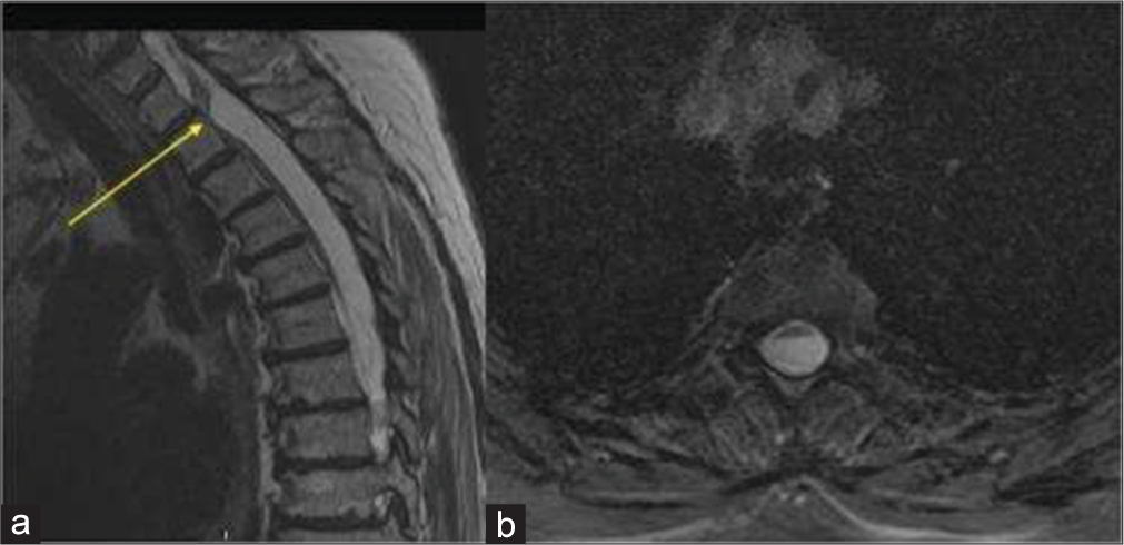 A 76-year-old female who presented with progressive onset difficulty in walking, leg weakness, and gait ataxia. (a) Sagittal T2-weighted and (b) Axial T2 gradient images of the thoracic spine demonstrating anterior cord kink at T2-3 level representing anterior spinal cord herniation (Yellow arrow).