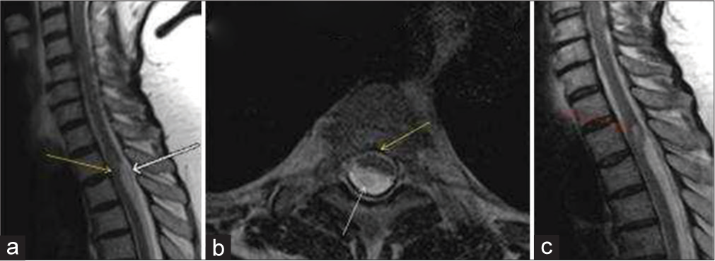 A 76-year-old female who presented with progressive onset difficulty in walking, leg weakness, and gait ataxia. (a) Sagittal and (b) Axial T2-weighted images of the thoracic spine demonstrating anterior cord displacement (“C” shaped kink) of the spinal cord with an associated kink at T4-5 level representing anterior spinal cord herniation (Yellow arrows). Posterior to the kink, CSF pulsation artifacts are seen in the posterior subarachnoid space (White arrows). (c) Sagittal T2-weighted image of the thoracic spine demonstrating a focal swelling with small intramedullary T2 hyperintensity is seen in the spinal cord just proximal to the kink representing a focal syrinx (Red arrow).