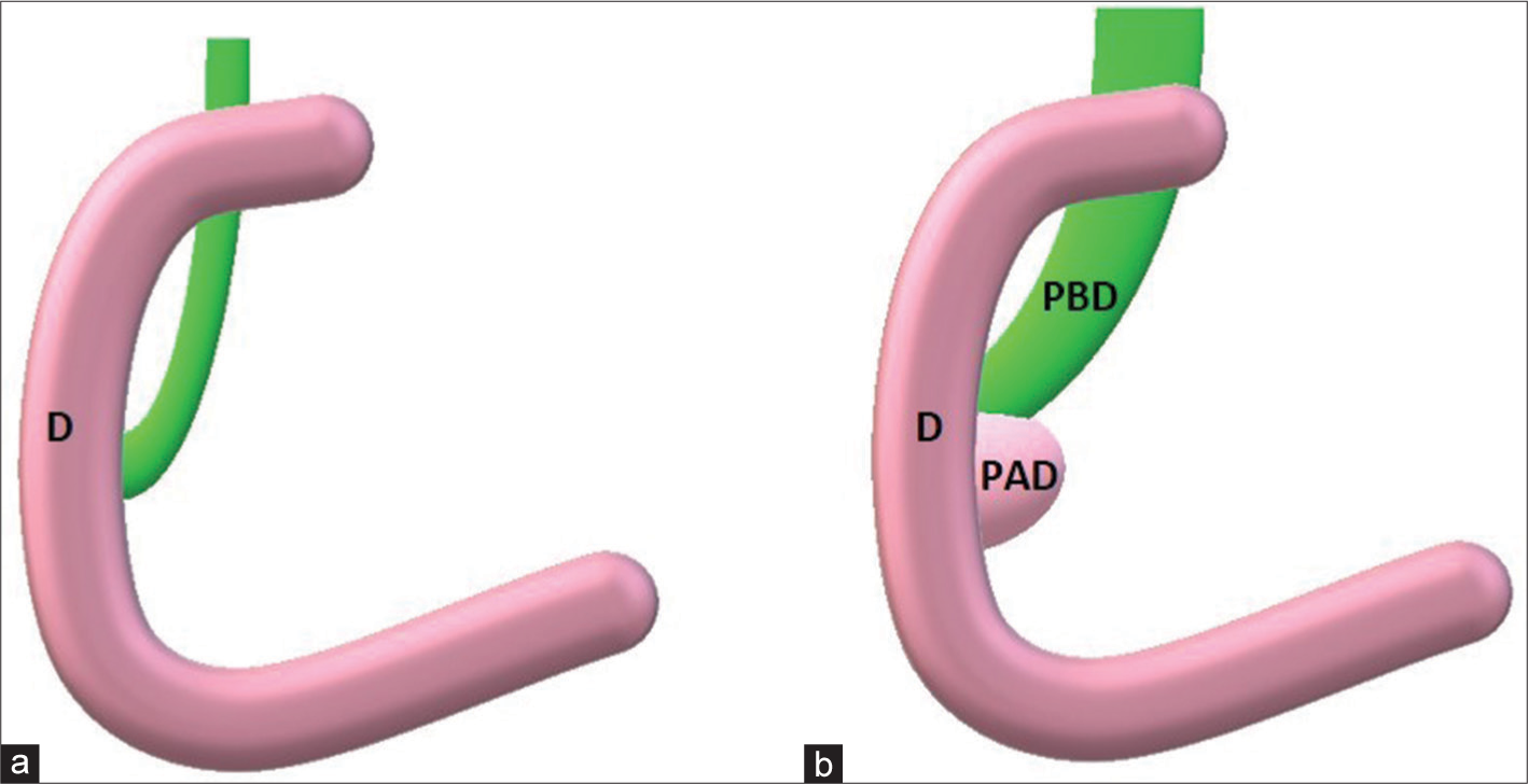 Schematic representation of periampullary duodenal diverticulum. (a) Principal bile duct normally between 4 and 8 mm in maximum diameter. (b) When a periampullary duodenal diverticulum is present, its extrinsic compression could enlarge periampullary duodenal diverticulum till obstructive jaundice. (PBD = Principal bile duct; PAD = Periampullary duodenal diverticulum; d = duodenum).