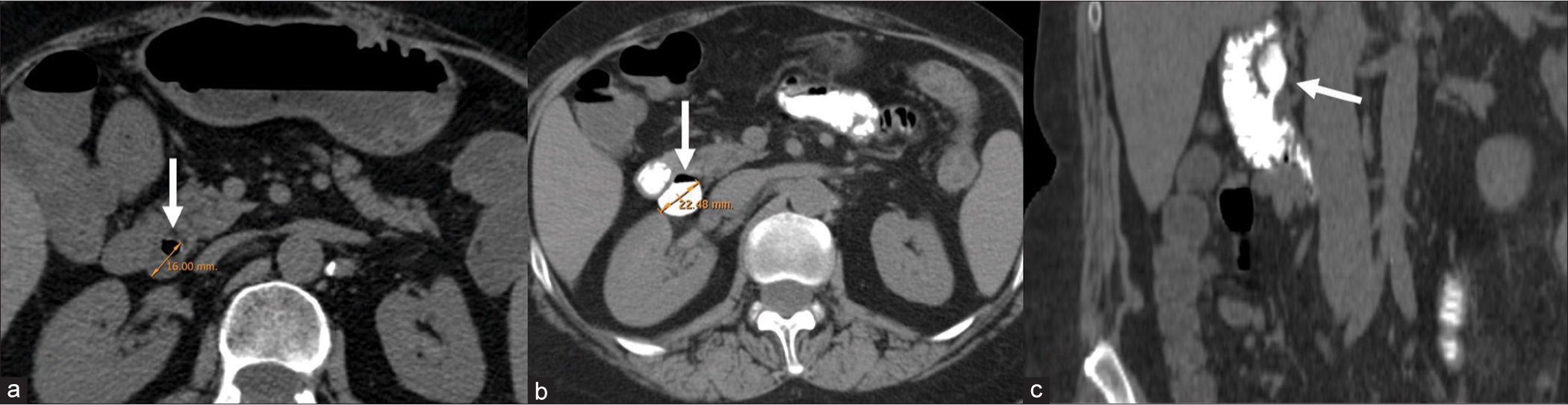 A 64-year-old woman with a history of recurrent postprandial epigastric pain. After US examination, which demonstrated common bile duct dilatation in the absence of lithiasis nuclei, the patient underwent unenhanced computed tomography (a), which demonstrated a periampullary duodenal diverticulum (white arrow) with a strict neck. Oral contrast was administered to better identify diverticulum, which was increased in maximum diameter (b) from 16 mm to 22 mm. (c) Coronal reconstruction shows periampullary duodenal diverticulum with a cranial ventral growth/expansion.