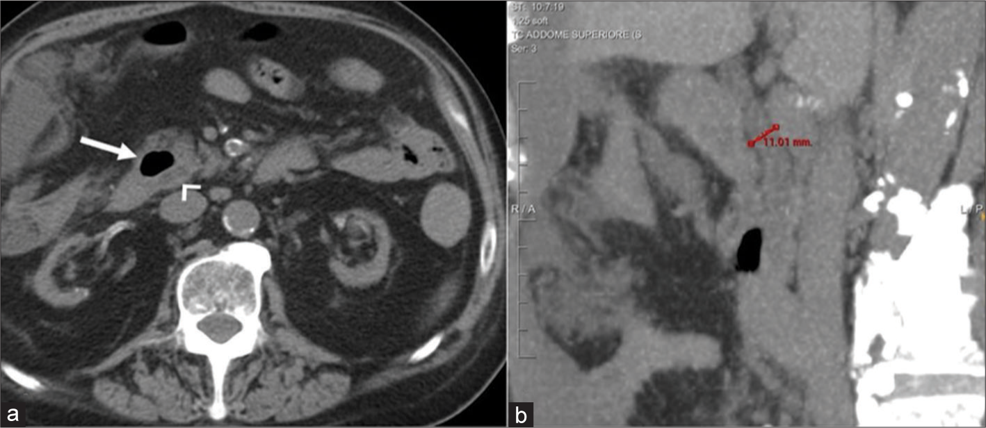 A 79-year-old man presented with epigastric pain. Unenhanced computed tomography scan of the abdomen demonstrated a 27-mm periampullary duodenal diverticulum filled with air (arrow in a) strictly adjacent to the distal portion of the common bile duct (arrowhead in a) which is 11 mm in maximum diameter (b). Symptoms regressed after NG decompression.