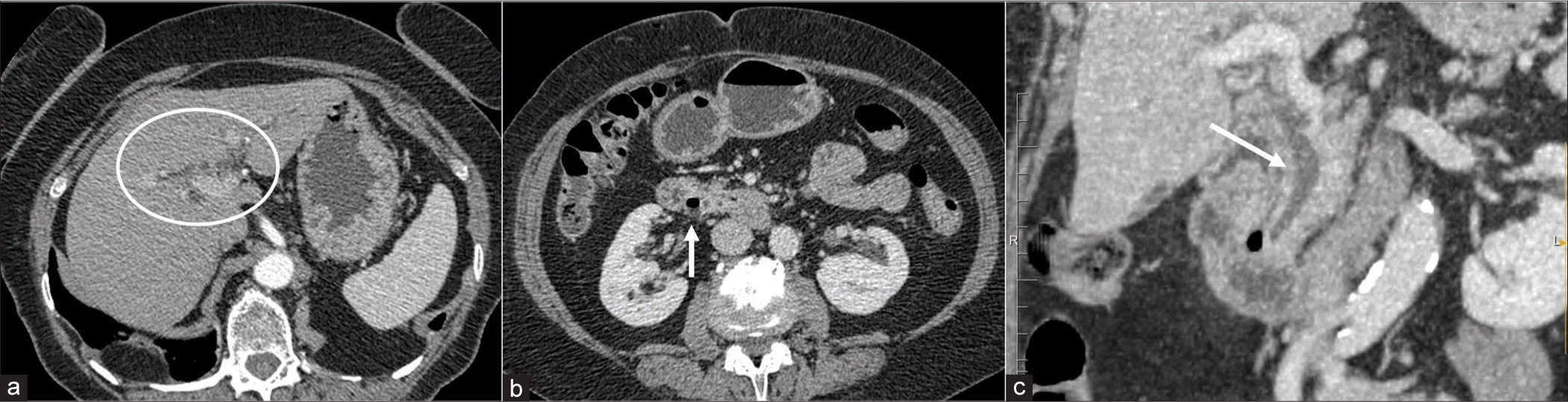 Contrast-enhanced computed tomography in a 70-year-old woman with nausea, vomiting, and slight jaundice. Intrahepatic bile duct dilatation is shown in a (white circle) with a small periampullary duodenal diverticulum with airfluid level demonstrated in b (arrowhead). Coronal reconstruction (c) highlights common bile duct dilatation and its close relation with periampullary duodenal diverticulum (arrow).