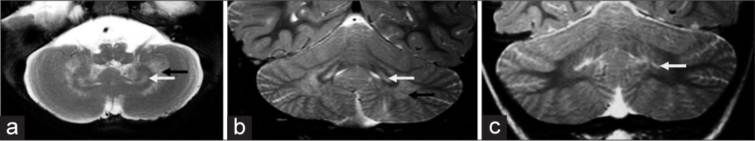 Patterns of dentate nucleus involvement in Krabbe disease. A 10-month-old boy with early infantile onset Krabbe disease -T2 axial and T2 coronal images (a, b) of shows sandwich appearance of dentate nucleus with hyperintensity of dentate hilum and surrounding cerebellar white matter. A 5-year-old girl of Juvenile subtype - T2 coronal image (c) showing isolated dentate hilum hyperintensity.