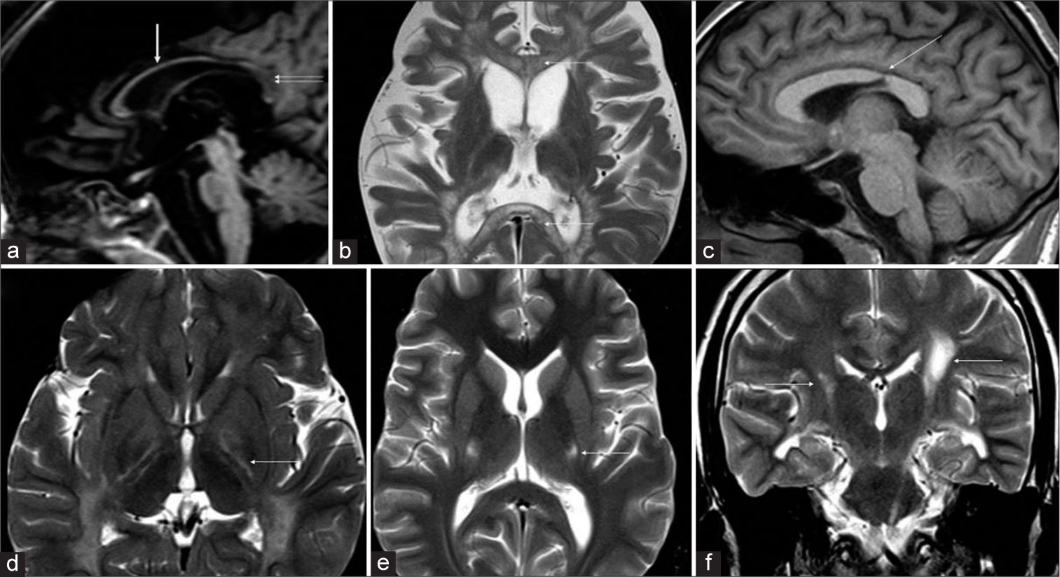 Patterns of involvement of corpus callosum (a-c) and posterior limb of internal capsule (PLIC) (d-f) in Krabbe disease. T1 sagittal (a) shows diffuse thinning of the corpus callosum (white arrow) with signal changes of posterior body and splenium (double arrows). T2 axial (b) image in a child with early infantile onset shows diffuse involvement of genu and splenium with tigroid pattern (white arrows). T1 sagittal image (c) in an adult subtype demonstrates the typical focal narrowing of an isthmic region of the corpus callosum (white arrow). T2 axial image (d) shows trilaminar appearance of PLIC (white arrow). T2 axial image (e) in adult-onset subtype shows symmetric involvement of middle-third of PLIC (white arrow) and T2 coronal image (f) shows asymmetrical involvement of the corticospinal tracts (white arrows).