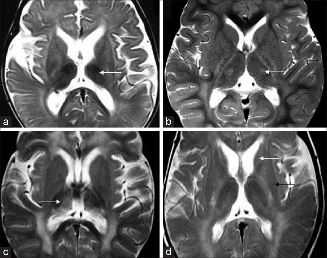 Thalamus and basal ganglia findings in Krabbe disease. Axial T2 (a) shows bilateral symmetric thalamic volume loss with T2 hypointensity in early infantile subgroup (white arrow).T2 axial in another case (b) shows bilateral ventrolateral thalamic hyperintensity (white arrow). T2 axial image (c) in yet another case shows more heterogeneous appearance with hypointensity and hyperintensity along medial apsect. T2 axial image (d) shows volume loss and hyperintensity of caudate head (white arrow) and putaminal volume loss with posterior hypointensity (black arrow).