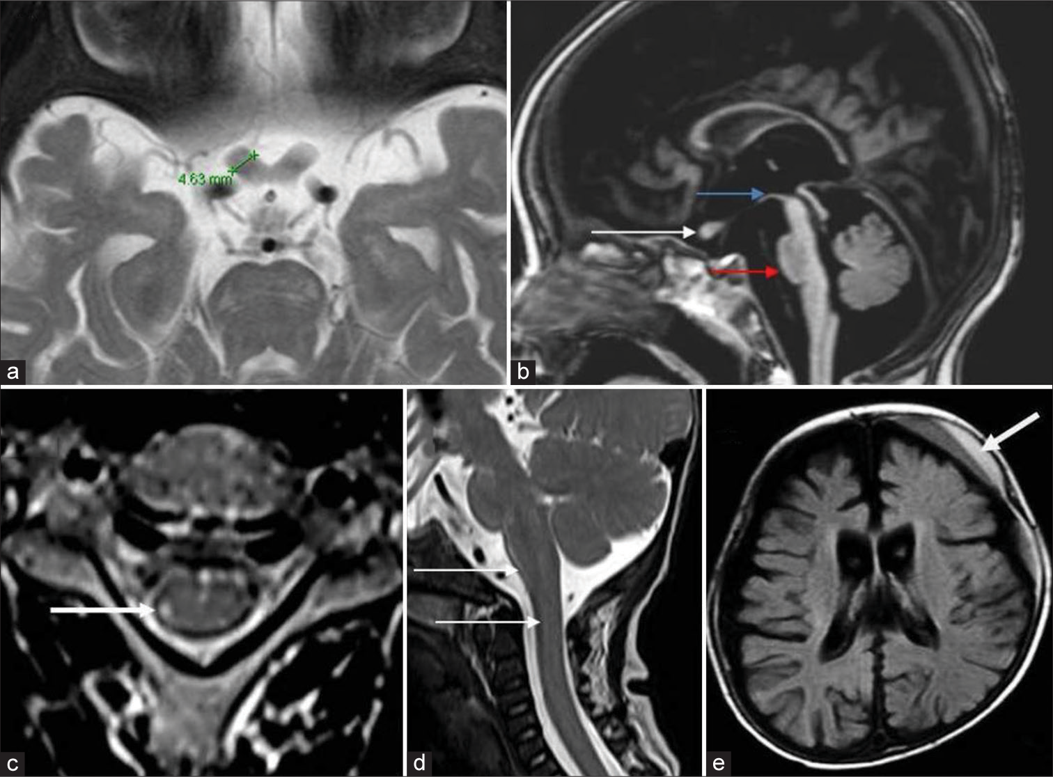 Optic nerves, brainstem, cord, and miscellaneous findings in Krabbe disease. A 7-month-old boy with early infantile Krabbe disease - T2 axial image (a) shows thickening of the prechiasmatic optic nerve which measures 4.6 mm. T1 sagittal image (b) shows the thickened optic nerve (white arrow) and moderate volume loss of midbrain (blue arrow) with hummingbird morphology and significant pontine volume loss (red arrow), axial T2 images of cervical cord in an adolescent onset case show hyperintensity of the lateral spinothalamic tract (white arrow). T2 sagittal image (d) in an early infantile onset subtype shows enlargement of cervical cord and lower brainstem (white arrows). Axial fluid-attenuated inversion recovery image (e) shows left frontal subdural collection with layered appearance (white arrow) with diffuse cerebral atrophy.