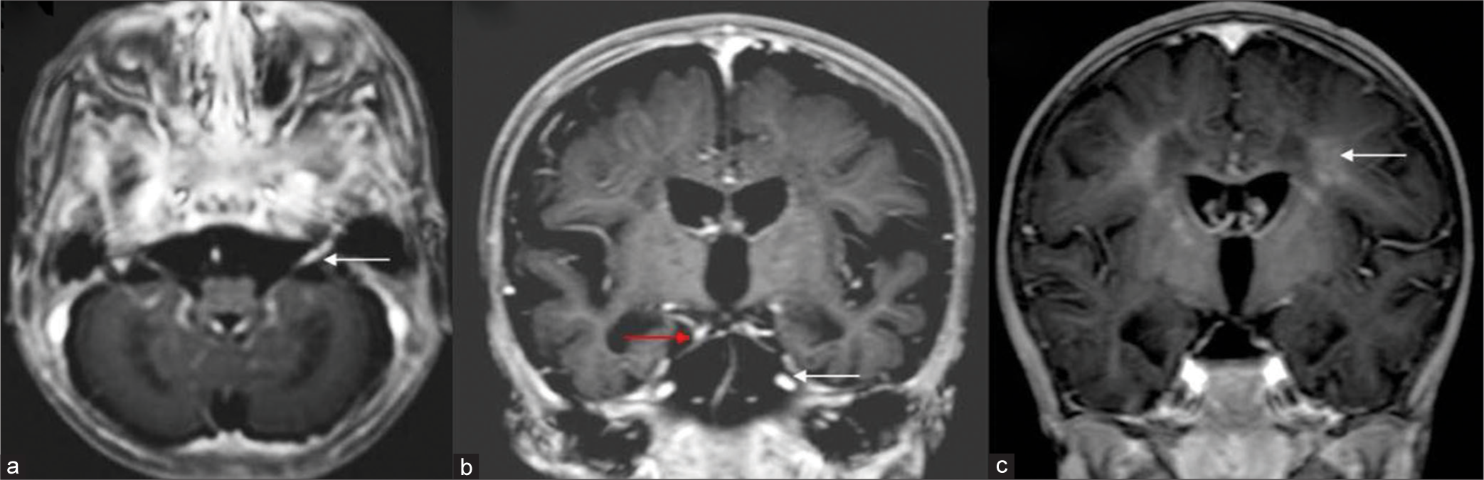 Cranial nerve and white matter enhancement. T 1 axial post-contrast image (a) shows bilateral thickening and enhancement of eighth nerve (white arrow). T1 post-contrast coronal image (b) shows enhancement along third (red arrow) and fifth nerves (white arrow) bilaterally. T1 coronal post-contrast image (c) in another child shows patchy deep white matter enhancement (white arrow).