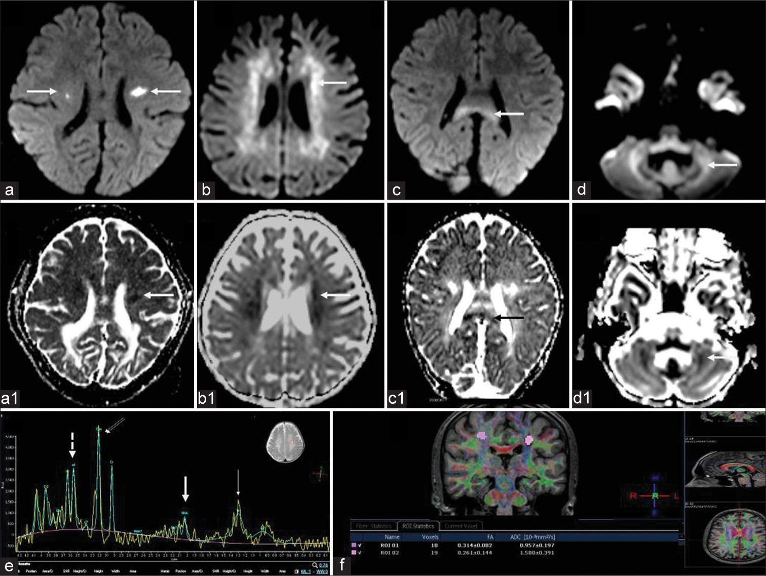 Diffusion-weighted imaging (DWI), magnetic resonance spectroscopy, and diffusion tensor imaging (DTI) findings in Krabbe disease. DWI (a-d) and corresponding ADC maps (a1-d1) in different cases show asymmetric restricted diffusion of corticospinal tracts (CSTs) (a) periventricular white matter (b), callosal splenium (c), and cerebellar white matter (d). Magnetic resonance spectroscopy from deep white matter at TE 135 (e) shows N-acetyl aspartate reduction (thick arrow) small lipid peak(thin arrow) and relative choline (double arrows) and myoinositol (dashed arrow) elevation. DTI from CSTs (f) in a case of adult-onset subtype shows reduced fractional anisotropy values.