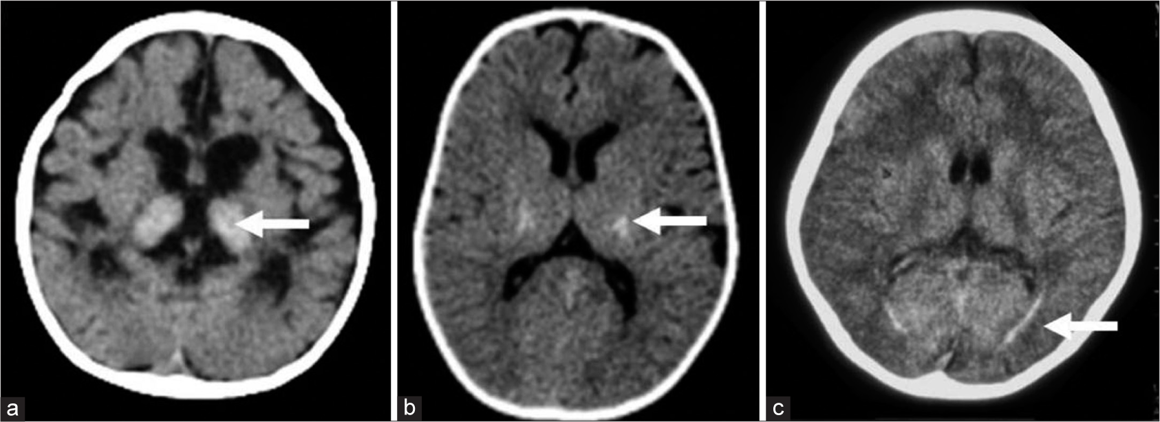 Computed tomography (CT) findings in Krabbe disease. A 9–month- old girl with progressive neuroregression diagnosed as early infantile Krabbe disease - axial CT (a) shows bilateral thalamic hyperdensity (white arrow) with significant cerebral volume loss. Axial CT image in a case with juvenile onset (b) shows bilateral symmetric hyperdensity along posterior limb of internal capsule (white arrow). Axial CT in an adult-onset case (c) depicts hyperdensity (white arrow) along optic radiations bilaterally.