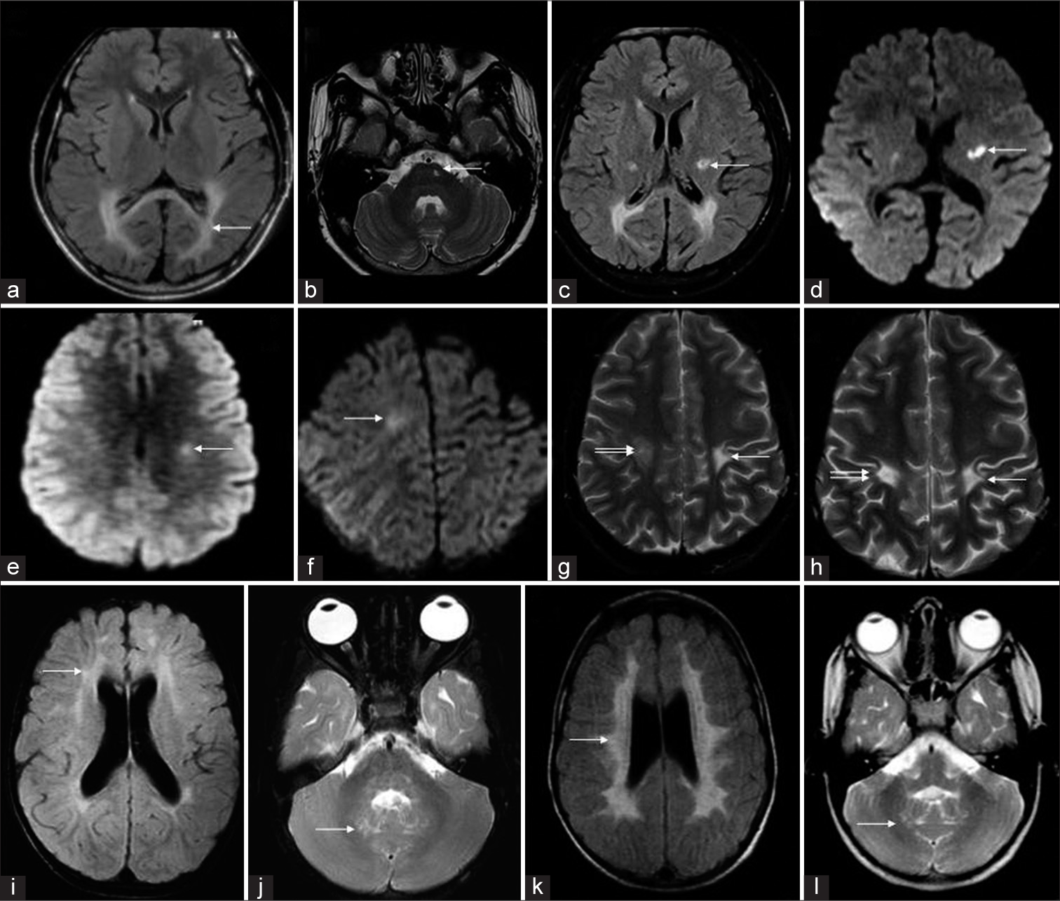 Temporal evolution of different cases of Krabbe disease on serial magnetic resonance imaging (MRI). A 6-year-old boy with Juvenile Krabbe (a-d) - initial fluid-attenuated inversion recovery (FLAIR) axial image (a) shows confluent posterior periventricular and splenial hyperintensity (white arrow). T2 axial (b), FLAIR axial (c), and diffusion-weighted imaging (DWI) (d) images from subsequent MRI done after 3 years show asymmetric CST involvement with bilateral restricted diffusion(arrows). A 14-year-old boy who presented initially with right hemiparesis which progressed to spastic quadriparesis over a 3-year period. Serial MRI (e-h) shows initial DWI with mild left CST restricted diffusion. Subsequent MRI (f) shows a new area of restricted diffusion along right CST. T2 axial (g) acquired at the same time shows chronic changes on the left side and more acute changes on the right. Later, MRI shows bilateral chronic changes along CST (h). Serial MRI (i-l) of a 5-year-old girl from juvenile group shows patchy scattered white matter changes on initial FLAIR axial image (i) progressing to confluent involvement with tigroid pattern in a subsequent MRI done after 34 months (k). Both scans (j, l) show dentate hilum involvement with sparing of deep cerebellar white matter.