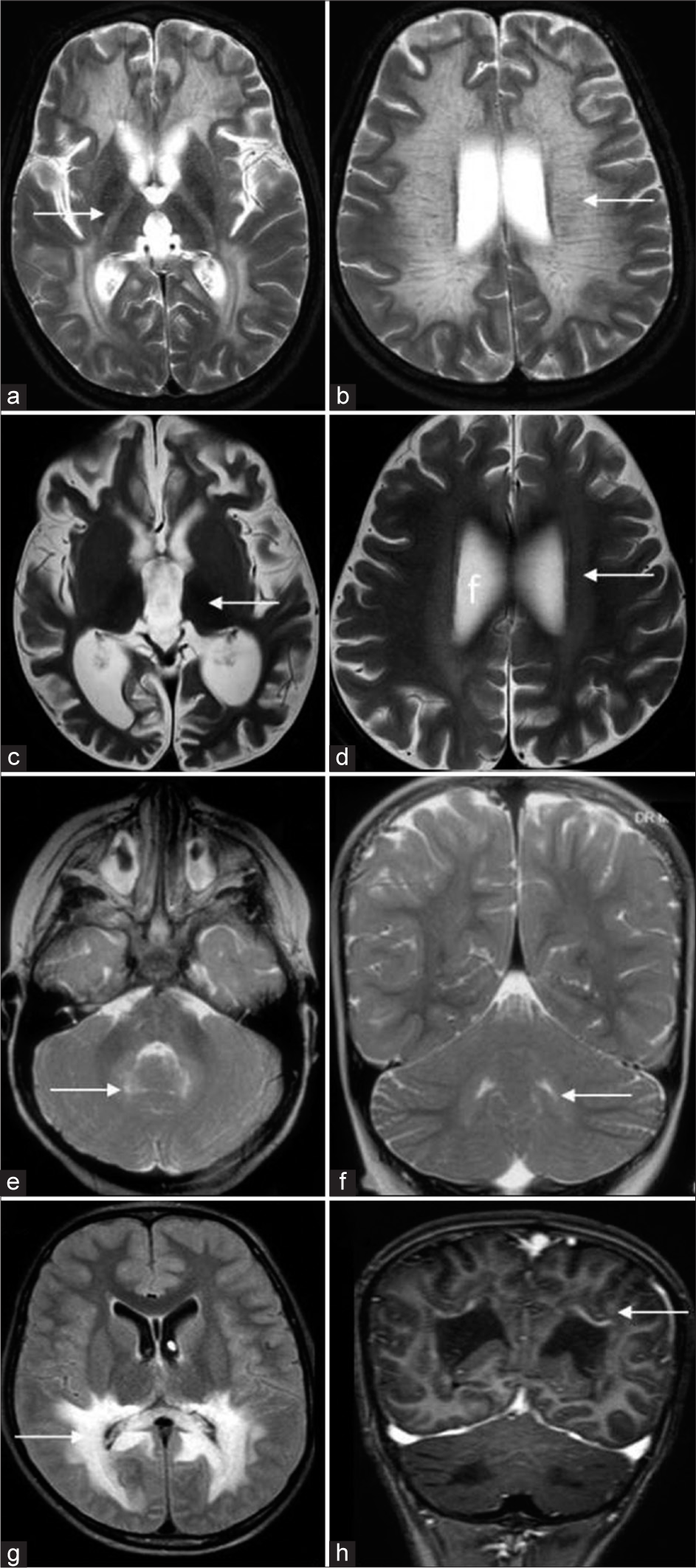 Differential diagnosis of Krabbe disease. T2 axial (a, b) of a case of metachromatic leukodystrophy shows diffuse white matter hyperintensity (white arrow in a) with posterior limb of internal capsule involvement and tigroid appearance (white arrow in b). T2 axial images (c, d) of a case of neuronal ceroid lipofuscinosis show diffuse thalamic volume loss and hypo intensity (white arrow in a) and subtle white matter hyperintensity (white arrow in b). T2 axial and coronal images (e, f) of peroxisome biogenesis disorder show dentate hilum hyperintensity (white arrows). Fluid-attenuated inversion recovery axial and T1 post-contrast coronal images of adrenoleukodystrophy (g, h) show confluent posterior periventricular and callosal splenial hyperintensity (white arrow in a) with enhancement of the intermediate zone (white arrow in b).