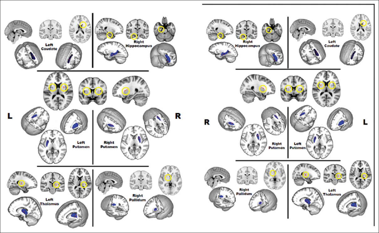 Statistic maps of shape difference in different subcortical regions (the right hippocampus, left and right putamen, left thalamus, left caudate, and right pallidum) between schizophrenia and control. The red color on the three-dimensional mesh and the yellow circle on the sagittal, coronal, and transverse anatomical slices in standard Montreal Neurological Institute space demonstrate the region with shape significant difference between two groups.