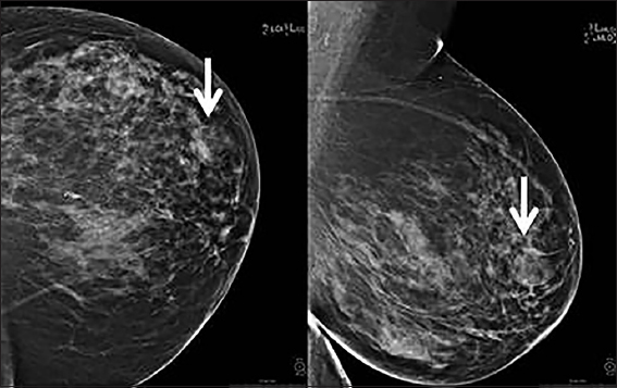 A 66-year-old female with abnormal screening mammogram showing a mixed density circumscribed mass with areas of fat density in the left breast at the 3 o’clock position (arrow).