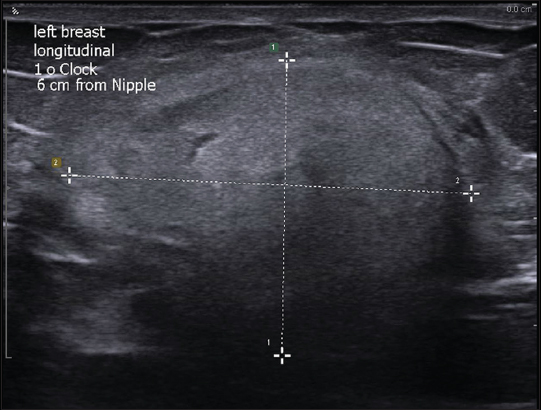 A 66-year-old female with external ultrasound showing well-circumscribed hyperechoic mass in the left breast.