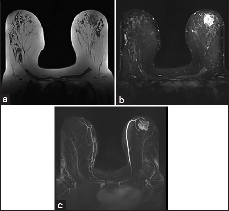 A 66-year-old female with breast magnetic resonance imaging shows heterogeneous mass with areas of T1 hyperintensity (a) suppressing on short-tau inversion recovery (b) in the left breast. Postcontrast maximum intensity projection image shows irregularly enhancing mass (c).
